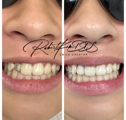 Chino Hills Dentist - Avion Dental – Chino Hills, CA | Smile Transformations & Gentle Dentistry

At Avion Dental, we’re proud to serve the Chino Hills community with advanced, compassionate dental care that blends artistry and technology. Led by Dr. Robert Kim, DDS, our team specializes in creating confident, healthy smiles through cosmetic dentistry, dental implants, and full-arch restorations — all tailored to your unique needs.

Our project portfolio showcases real patient transformations, from single-tooth implants to full smile makeovers. Whether you’re coming in for a routine cleaning, a same-day crown, or a complete restoration, every detail is designed for comfort, precision, and results that last.

✨ Featured Services:
• Dental Implants & Full-Arch (All-on-4) Restorations
• Cosmetic Dentistry & Smile Design
• Same-Day Crowns (CEREC)
• Teeth Whitening & Veneers
• Gentle Cleanings & Preventive Care

📍 Located at 4665 Chino Hills Pkwy Suite D, Chino Hills, CA 91709
Our modern office welcomes patients from Chino Hills, Chino, Diamond Bar, Yorba Linda, and surrounding areas.

💎 Experience why locals call Avion Dental the #1 Dentist in Chino Hills for comfort, technology, and stunning smile transformations.
