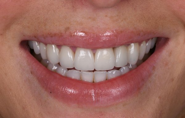 Porcelain Veneers Newport Beach, CA - This patient enured a golf cart accident and received three root canals. She nearly lost several teeth before she came to Spath Dentistry and we were able to save them! We have seen and treated many dental emergencies in Newport Beach, CA. We were able to utilize our dental skill set and used six porcelain veneers to create a seamless experience and a natural looking smile. As a Newport Beach cosmetic dentist we're able to restore smiles and confidence.