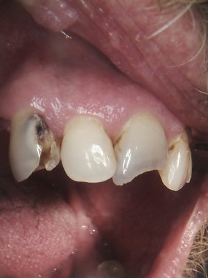 July 2025, an anterior make over - The case had extensive decay visible on the upper front teeth. We fixed it in a day. July 2025, an anterior make over - The case had extensive decay visible on the upper front teeth. We fixed it in a day.