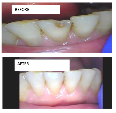 Composite Filling - Composite filling on chipped tooth. Composite Filling - Composite filling on chipped tooth.