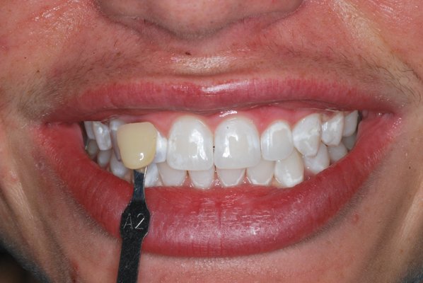 Teeth Whitening - teeth whitening is the quickest way to lift a smile to a younger and healthier look.  It can be done quickly and the results speak for themselves.  All of these photos are patients treated in our office.  It is a predictable procedure for us.