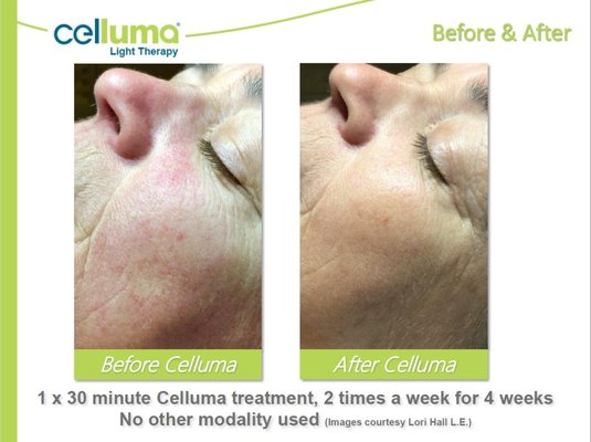 LED Before & After - Before & After results using the various modes of Celluma Pro LED device. The modes are Acne, Wrinkles (anti-aging), Aches & Pains. Results will vary from person to person. Some clients have purchased a Celluma Home device as the cost of 10 treatments can equal buying a home device. The home device has only two modes and we can advise you on which home device to purchase depending on your goals. LED Before & After - Before & After results using the various modes of Celluma Pro LED device. The modes are Acne, Wrinkles (anti-aging), Aches & Pains. Results will vary from person to person. Some clients have purchased a Celluma Home device as the cost of 10 treatments can equal buying a home device. The home device has only two modes and we can advise you on which home device to purchase depending on your goals.