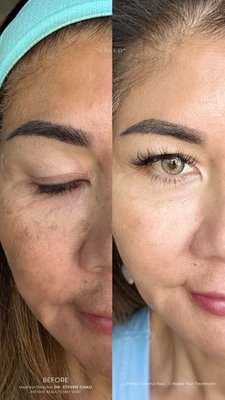Derma Peel - Derma Peel Derma Peel - Derma Peel