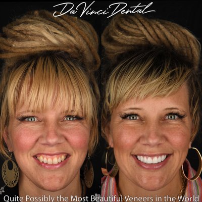 Gum Lift with Veneers - The “Gummy Smile” is an extremely common smile feature that many wish they could correct. This issue of excessive gum display will often also have teeth that appear too small or too short. This is due to the fact that when the gum tissue is too tall, it creates an unbalance in the gum to tooth ratio. The gummy smile is such a common issue that you’ll notice we have numerous cases on our profile. Our “Gum Lift” procedure is included at no charge with all our Veneer cases, and it’s surprisingly fast and painless. Many patients that we have helped said they wished they had known sooner it could be corrected so quickly and effectively.
Excessive gums often leaves people trying to control their smiling habits to limit how much of their gums they expose. Many people have told us that because they have a gummy smile, they say they choose when they smile to simply not open their lips at all. Patients like this that are affected emotionally by issues with their smile, are the ones Dr. Keller gets the most fulfillment from helping. Imagine being able to deliver a permanent boost in confidence to someone? This is the power of what we do at Da Vinci Dental, and why we love it so much!