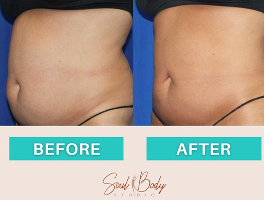 Body Contouring - Soul Body Studio is dedicated to sculpting the body you’ve always wanted. We will reduce fat in unwanted areas, tone and define your body and face. Our non-surgical, low-level laser procedures are proven to safely shrink fat cells in any area you choose to target. Allowing you to tone, define, and sculpt your waist, thighs, calves and stomach. We also specialize in reducing the appearance of cellulite. Our method is painless and requires no surgery, no downtime and is a much safer and healthier alternative.
Call us today for a free consultation! Body Contouring - Soul Body Studio is dedicated to sculpting the body you’ve always wanted. We will reduce fat in unwanted areas, tone and define your body and face. Our non-surgical, low-level laser procedures are proven to safely shrink fat cells in any area you choose to target. Allowing you to tone, define, and sculpt your waist, thighs, calves and stomach. We also specialize in reducing the appearance of cellulite. Our method is painless and requires no surgery, no downtime and is a much safer and healthier alternative.
Call us today for a free consultation!