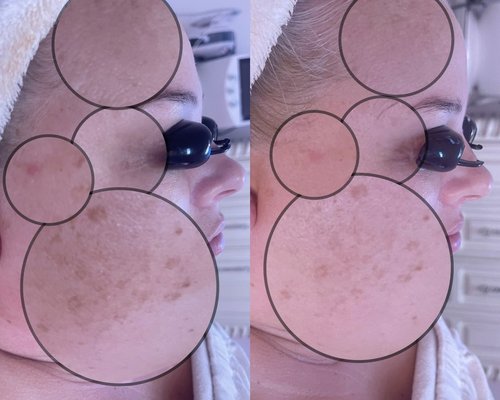 Dream Custom Facial - Dream Custom Facial + Enzymes treats pigmentation, acne, wrinkles, sun damage, tired skin. Dream Custom Facial - Dream Custom Facial + Enzymes treats pigmentation, acne, wrinkles, sun damage, tired skin.