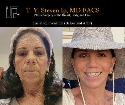 The Ultimate Facelift (Facial Rejuvenation) by T. Y. Steven Ip, MD - This wonderful patient was very self conscious of her appearance and found herself no wanting to go to public spaces. Through encouragement from her friends and family, she decided to make a change for herself. She underwent a facelift, browlift, and full face CO2 laser resurfacing. These are photos sent by my patient to me. She is only 2weeks post-op and is extremely happy, having lunch with her friends. This is a life changing surgery for her. The Ultimate Facelift (Facial Rejuvenation) by T. Y. Steven Ip, MD - This wonderful patient was very self conscious of her appearance and found herself no wanting to go to public spaces. Through encouragement from her friends and family, she decided to make a change for herself. She underwent a facelift, browlift, and full face CO2 laser resurfacing. These are photos sent by my patient to me. She is only 2weeks post-op and is extremely happy, having lunch with her friends. This is a life changing surgery for her.