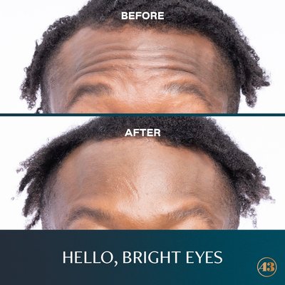 Botox/Dysport Results - Wrinkle relaxers such as Botox and Dysport aid in smoothing out fine lines for a refreshed look.
