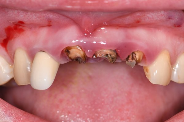 anterior teeth bridge - Patient came in due to severe inflammation with broken front teeth. Gum graft was done with bridge restoration. Patient was so happy about results!! anterior teeth bridge - Patient came in due to severe inflammation with broken front teeth. Gum graft was done with bridge restoration. Patient was so happy about results!!