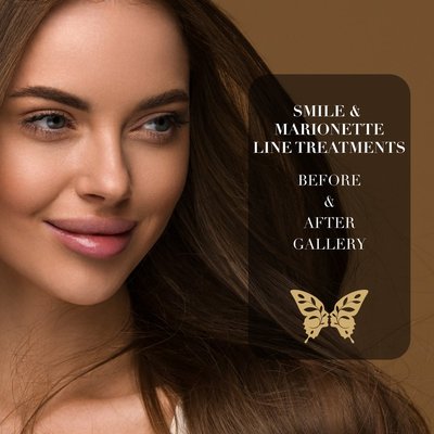 Smile & Marionette Line Treatments - Smile lines, nasolabial folds, and marionette lines can all be treated with injections to reduce their appearance. This results is some amazingly youthful appareances. Smile & Marionette Line Treatments - Smile lines, nasolabial folds, and marionette lines can all be treated with injections to reduce their appearance. This results is some amazingly youthful appareances.