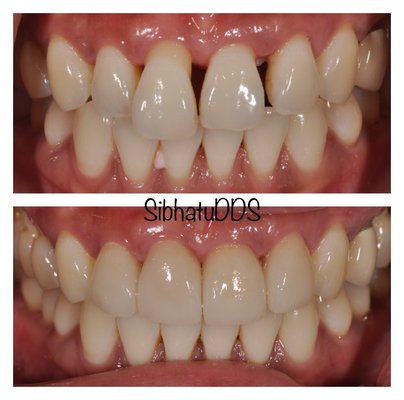 Dental Implants - Dental Implants are great solutions to replace missing teeth because they look and feel just like natural teeth. Dental Implants - Dental Implants are great solutions to replace missing teeth because they look and feel just like natural teeth.
