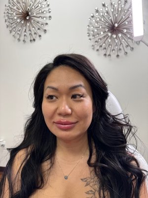 Lip Filler - Great Results! Lip Filler - Great Results!