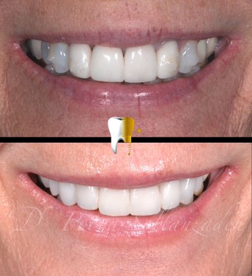 Natural looking porcelain veneers. - Third time is the charm! Patient not liking her porcelain veneers previously done by other dentists due to bulkiness and unnatural look. Requesting more natural and straight look. There you go…#smilemakeover #porcelainveneer #porcelainveneers #esthetics #cosmeticdentist #cosmeticdentistry #orangecountydentist #orangecountyprosthodontics #orangecountyprosthodontist #beauty #celebritydentist #cosmetics #veneers #anaheimhills #yorbalinda #yorbalindabuzz #anaheimhillsbuzz #pooya_soltan_zadeh_dds Natural looking porcelain veneers. - Third time is the charm! Patient not liking her porcelain veneers previously done by other dentists due to bulkiness and unnatural look. Requesting more natural and straight look. There you go…#smilemakeover #porcelainveneer #porcelainveneers #esthetics #cosmeticdentist #cosmeticdentistry #orangecountydentist #orangecountyprosthodontics #orangecountyprosthodontist #beauty #celebritydentist #cosmetics #veneers #anaheimhills #yorbalinda #yorbalindabuzz #anaheimhillsbuzz #pooya_soltan_zadeh_dds