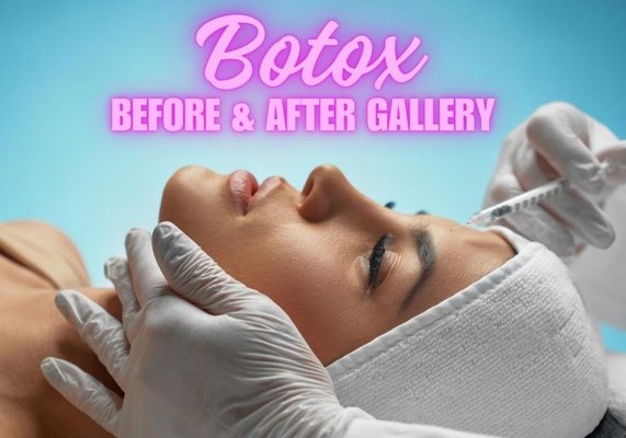 Botox Before & After Gallery - The most popular type of cosmetic injection by far is Botox. This unique formulation blocks signals from the nerves to the muscles. The injected muscle can no longer contract as forcefully, which causes the wrinkles to relax and soften. Even deep-set smile lines and crow's feet can be minimized by this process.
Because of its effectiveness, Botox is one of the most popular and effective treatments on the market today to tighten and smooth areas of the skin that are showing signs of aging.
The best part about these injections is that they are virtually painless and have little to no recovery time. You can come into our office, get your injection work performed, and be on your way in under half an hour! Botox Before & After Gallery - The most popular type of cosmetic injection by far is Botox. This unique formulation blocks signals from the nerves to the muscles. The injected muscle can no longer contract as forcefully, which causes the wrinkles to relax and soften. Even deep-set smile lines and crow's feet can be minimized by this process.
Because of its effectiveness, Botox is one of the most popular and effective treatments on the market today to tighten and smooth areas of the skin that are showing signs of aging.
The best part about these injections is that they are virtually painless and have little to no recovery time. You can come into our office, get your injection work performed, and be on your way in under half an hour!