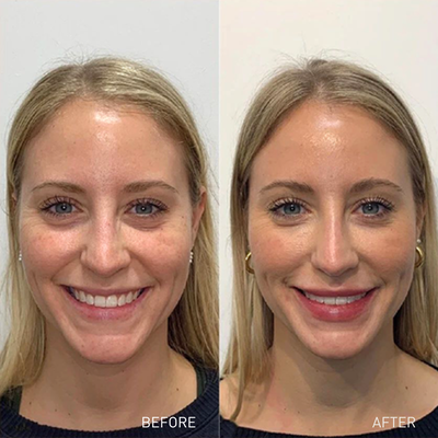 Dermal/Facial Filler Injections | Round Rock - Facial fillers or dermal fillers at Viva Day Spa + Med Spa in Round Rock are FDA approved are injectable substances that are placed strategically into parts of the face that have sunken, hallowed, lined or creased due to aging or are used to enhance contours in the cheek, chin, jaw, and more. All of our aesthetic injectables are administered by our trained medical injectors.
The two most common types of filler are H.A. or hyaluronic acid fillers (Juvéderm, Restylane) which provide immediate plumping and PLLA (Sculptra) which stimulates your body to produce new collagen over time. Dermal/Facial Filler Injections | Round Rock - Facial fillers or dermal fillers at Viva Day Spa + Med Spa in Round Rock are FDA approved are injectable substances that are placed strategically into parts of the face that have sunken, hallowed, lined or creased due to aging or are used to enhance contours in the cheek, chin, jaw, and more. All of our aesthetic injectables are administered by our trained medical injectors.
The two most common types of filler are H.A. or hyaluronic acid fillers (Juvéderm, Restylane) which provide immediate plumping and PLLA (Sculptra) which stimulates your body to produce new collagen over time.
