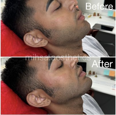 Facial Balancing - Non-surgical Lower face contour using Botox and Filler Facial Balancing - Non-surgical Lower face contour using Botox and Filler