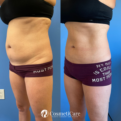 CoolSculpting - CoolSculpting is the #1 non-invasive fat reducing treatment that is FDA-approved for eliminating stubborn fat cells. In a single one-hour session, vacuum suction attachments are applied to spot-treat areas of concern with freezing technology to target and kill stubborn fat cells — and best of all, there’s no need for anesthesia or downtime for recovery!
As the #1 practice in Orange County, and with thousands of CoolSculpting cycles completed, you are truly in the best hands when choosing CosmetiCare for your fat-reducing treatment. CoolSculpting - CoolSculpting is the #1 non-invasive fat reducing treatment that is FDA-approved for eliminating stubborn fat cells. In a single one-hour session, vacuum suction attachments are applied to spot-treat areas of concern with freezing technology to target and kill stubborn fat cells — and best of all, there’s no need for anesthesia or downtime for recovery!
As the #1 practice in Orange County, and with thousands of CoolSculpting cycles completed, you are truly in the best hands when choosing CosmetiCare for your fat-reducing treatment.