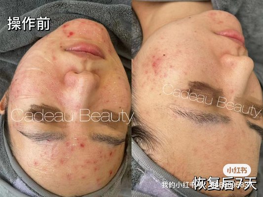 acne treatment - Acne treatment acne treatment - Acne treatment