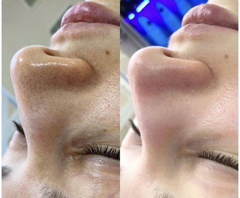 Whitening & Deep Pore Cleansing Facial - Our skin care products cleanse, hydrate, and balance the skin to impart a natural, healthy glow. Whitening & Deep Pore Cleansing Facial - Our skin care products cleanse, hydrate, and balance the skin to impart a natural, healthy glow.