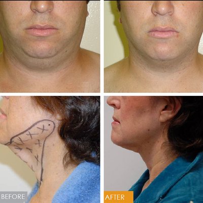 Smartlipo of the neck - Dr. Robert, has pioneered a Smartlipo technique that is more advanced than the traditional liposuction performed in many other centers. Having treated over 3000 patients with a 97% satisfaction rate Dr. Robert is considered one of the top national experts in body contouring. Using what has been described by other doctors as his "gentle technique" Dr. Robert performs the entire procedure under local anesethesia. Patients listen to music, sleep, or discuss current topics with Dr. Robert and his team and after a few hours walk out of the office with their new body. Would you like to lose your unwanted fat in Just One Treatment! NOW ONLY $899. Established in 2007 Smartlipo of the neck - Dr. Robert, has pioneered a Smartlipo technique that is more advanced than the traditional liposuction performed in many other centers. Having treated over 3000 patients with a 97% satisfaction rate Dr. Robert is considered one of the top national experts in body contouring. Using what has been described by other doctors as his "gentle technique" Dr. Robert performs the entire procedure under local anesethesia. Patients listen to music, sleep, or discuss current topics with Dr. Robert and his team and after a few hours walk out of the office with their new body. Would you like to lose your unwanted fat in Just One Treatment! NOW ONLY $899. Established in 2007