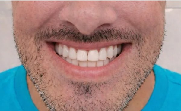 All-on-4 Full Mouth Dental Implants in Houston, TX - This before-and-after case highlights a full-mouth dental transformation completed at Texas Dental Center in Houston, TX.
The patient came to our office with severely compromised teeth that affected both the appearance and function of his smile. After a comprehensive dental evaluation and discussion of his treatment options, we developed a full-mouth rehabilitation plan using All-on-4 dental implants.
All-on-4 treatment is designed for patients who have lost many or all of their teeth, or whose remaining teeth can no longer be predictably restored. By strategically placing dental implants, we can support a fixed full-arch restoration and rebuild the patient’s smile without requiring an individual implant for every missing tooth.
For this patient, our goal was not simply to improve the appearance of his teeth. We also wanted to restore proper function, provide a stable and comfortable result, and create a natural-looking smile that complemented his facial features.
The before photo shows the condition of the patient’s teeth when he first presented to our office. The after photo shows his smile following completion of his All-on-4 full-mouth dental implant treatment.
Texas Dental Center provides comprehensive implant and restorative dentistry in Houston, including All-on-4 dental implants and full-mouth rehabilitation for patients with missing, failing, or severely damaged teeth.
Every patient and dental implant case is different. Treatment recommendations, procedures, healing time, and results depend on each patient’s individual dental and medical circumstances. All-on-4 Full Mouth Dental Implants in Houston, TX - This before-and-after case highlights a full-mouth dental transformation completed at Texas Dental Center in Houston, TX.
The patient came to our office with severely compromised teeth that affected both the appearance and function of his smile. After a comprehensive dental evaluation and discussion of his treatment options, we developed a full-mouth rehabilitation plan using All-on-4 dental implants.
All-on-4 treatment is designed for patients who have lost many or all of their teeth, or whose remaining teeth can no longer be predictably restored. By strategically placing dental implants, we can support a fixed full-arch restoration and rebuild the patient’s smile without requiring an individual implant for every missing tooth.
For this patient, our goal was not simply to improve the appearance of his teeth. We also wanted to restore proper function, provide a stable and comfortable result, and create a natural-looking smile that complemented his facial features.
The before photo shows the condition of the patient’s teeth when he first presented to our office. The after photo shows his smile following completion of his All-on-4 full-mouth dental implant treatment.
Texas Dental Center provides comprehensive implant and restorative dentistry in Houston, including All-on-4 dental implants and full-mouth rehabilitation for patients with missing, failing, or severely damaged teeth.
Every patient and dental implant case is different. Treatment recommendations, procedures, healing time, and results depend on each patient’s individual dental and medical circumstances.