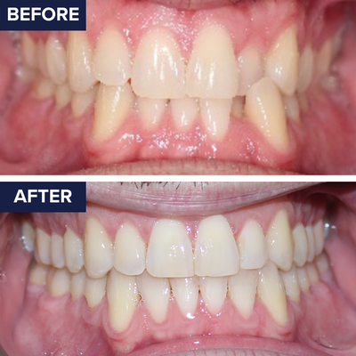 Invisalign® Before/After Treatment - Discover the clear way to a confident smile with Invisalign®! These virtually invisible aligners gently and effectively straighten teeth without metal brackets or wires. We create custom Invisalign® treatment plans to fit your lifestyle and deliver stunning, lasting results.
✨ Ready to smile with confidence? Book your Invisalign® consultation today! Invisalign® Before/After Treatment - Discover the clear way to a confident smile with Invisalign®! These virtually invisible aligners gently and effectively straighten teeth without metal brackets or wires. We create custom Invisalign® treatment plans to fit your lifestyle and deliver stunning, lasting results.
✨ Ready to smile with confidence? Book your Invisalign® consultation today!