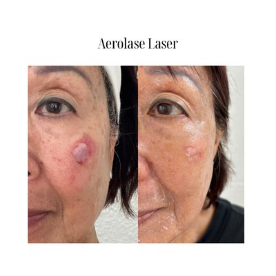 Aerolase Neo Elite - Aerolase is a cutting-edge, non-invasive laser treatment that safely and effectively targets a wide range of skin concerns—including acne, hyperpigmentation, rosacea, fine lines, and unwanted hair. Its unique 650-microsecond technology delivers powerful energy deep into the skin without damaging the surface, making it suitable for all skin types and tones with minimal discomfort or downtime.