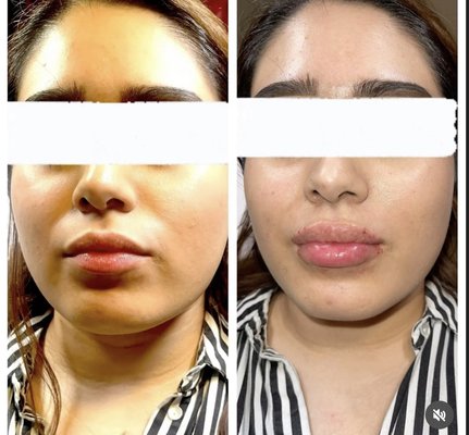 Lip fillers - Lip filler augmentation on all 3 clients to provide more volume and more youthful lips 
Lip fillers provide more symmetry and radiance to the lips for more volume and rejuvenation.