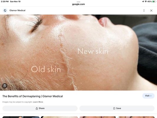 Dermaplaning - Dermaplaning is a process that gently removes dead skin and vellus hair (peach fuzz) using a disposable, sterilized scarple. This treatment results in clearer, fresher radiant skin.