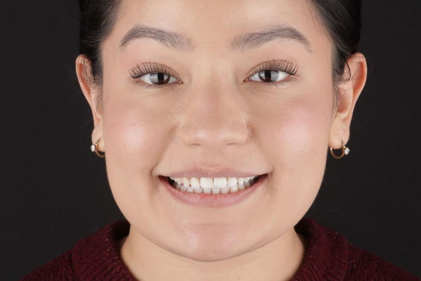 Invisalign - Our patient wanted a dazzling smile and came to us eager to make it a reality. But traditional braces were not her vibe. We used Invisalign to achieve her flawless smile. She now radiates confidence with a smile that she always envisioned. Invisalign - Our patient wanted a dazzling smile and came to us eager to make it a reality. But traditional braces were not her vibe. We used Invisalign to achieve her flawless smile. She now radiates confidence with a smile that she always envisioned.