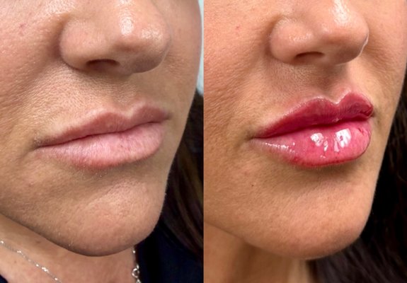 Lip Filler - This client received less than one syringe of Versa® hyaluronic acid dermal filler to gently enhance the lips. Treatment focused on improving mild asymmetry, refining the natural lip shape, and restoring balanced, natural-looking volume. Versa is known for its smooth texture, soft integration into the tissue, and hydration properties, making it ideal for subtle lip enhancement with natural results. Lip Filler - This client received less than one syringe of Versa® hyaluronic acid dermal filler to gently enhance the lips. Treatment focused on improving mild asymmetry, refining the natural lip shape, and restoring balanced, natural-looking volume. Versa is known for its smooth texture, soft integration into the tissue, and hydration properties, making it ideal for subtle lip enhancement with natural results.