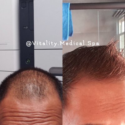 Vital Hair Treatment - PRP Hair Restoration - This client received one treatment of our Vital Hair restoration. Using your body's own blood, Platelet Rich Plasma is extracted and then injected directly into the scalp to stimulate the hair follicles. PRP helps those with male or female pattern balding, helping to repair balding appearance and also thicken areas of already existing hair. Treatment may be repeated in 2-3 months, depending on your results, and is followed by maintenance every 12 or 18 months. Vital Hair Treatment - PRP Hair Restoration - This client received one treatment of our Vital Hair restoration. Using your body's own blood, Platelet Rich Plasma is extracted and then injected directly into the scalp to stimulate the hair follicles. PRP helps those with male or female pattern balding, helping to repair balding appearance and also thicken areas of already existing hair. Treatment may be repeated in 2-3 months, depending on your results, and is followed by maintenance every 12 or 18 months.