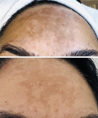 Treatments
Anti-aging
Acne
Hyperpigmentation
Melasma - Anti-aging Treatments
Ultra MD Laser helps with
Acne Treatment
hyperpigmentation
Melasma
Wrinkles Treatments
Anti-aging
Acne
Hyperpigmentation
Melasma - Anti-aging Treatments
Ultra MD Laser helps with
Acne Treatment
hyperpigmentation
Melasma
Wrinkles