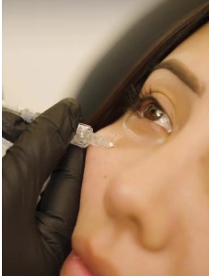 Undereye Filler - Filler in the hollowed under eye region with good skin elasticity can give a more restful and smooth appearance. This treatment is ideal for clients with hollowness which is not caused by large fat pockets or under eye bags and instead as a result of genetics or general aging process. Our Artist Injectors will do a thorough evaluation to discuss what is needed for you to achieve your desired result and educate if more than one syringe over a course of time is necessary to reach your goal. Undereye Filler - Filler in the hollowed under eye region with good skin elasticity can give a more restful and smooth appearance. This treatment is ideal for clients with hollowness which is not caused by large fat pockets or under eye bags and instead as a result of genetics or general aging process. Our Artist Injectors will do a thorough evaluation to discuss what is needed for you to achieve your desired result and educate if more than one syringe over a course of time is necessary to reach your goal.