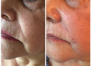 Dermal Fillers - Treatment with dermal fillers (such as Versa, Juvederm Ultra and Ultra Plus XC, Voluma XC, Volbella XC and Vollure) can smooth out facial folds and wrinkles, add volume to the lips, and contour facial features that have lost their volume and fullness due to aging, sun exposure, illness, etc.