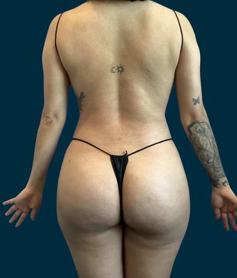 Brazilian Butt Lift - Brazilian Butt Lift and liposuction performed by Dr. Amir Partovi. Patient is 28 and after images were captured at 2 months post-op. Brazilian Butt Lift - Brazilian Butt Lift and liposuction performed by Dr. Amir Partovi. Patient is 28 and after images were captured at 2 months post-op.