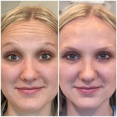 Neurotoxin - Smooth out your fine lines and wrinkles with either Botox, Dysport or Jeuveau. Your provider will customize a treatment plan specifically for you and your aesthetics goals! Neurotoxin - Smooth out your fine lines and wrinkles with either Botox, Dysport or Jeuveau. Your provider will customize a treatment plan specifically for you and your aesthetics goals!