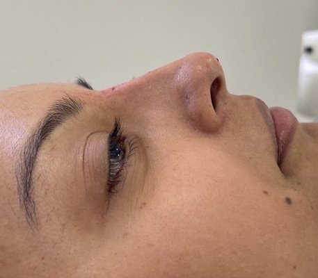 Naked Nose® Non Surgical Nose Job (NSNJ) - Ideal for people who are looking to smooth out bumps on their nose, enhance their bridge, lift or add structure to the tip. Although a NSNJ may change the appearance anteriorly, it mainly affects the lateral or “side” profile. When HA filler is placed properly, it may give the illusion of a smaller and thinner nose. A NSNJ does not remove volume from the nose or shorten it. Naked Nose® Non Surgical Nose Job (NSNJ) - Ideal for people who are looking to smooth out bumps on their nose, enhance their bridge, lift or add structure to the tip. Although a NSNJ may change the appearance anteriorly, it mainly affects the lateral or “side” profile. When HA filler is placed properly, it may give the illusion of a smaller and thinner nose. A NSNJ does not remove volume from the nose or shorten it.