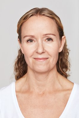 Restylane - Before and after Restylane