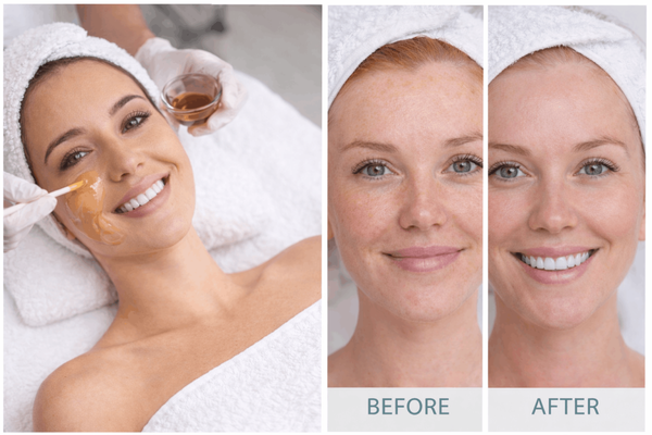 145$+ - Chemical Peels - eveal smoother, clearer, brighter skin with our professional Chemical Peel treatments at Highlands Spa. Chemical peels are one of the most effective ways to improve your skin’s tone and texture by gently exfoliating the top layers of skin to encourage fresh, healthy cell turnover.
Our peels help target common concerns like acne, fine lines, sun damage, dark spots, uneven pigmentation, rough texture, and dull skin—leaving you with a refreshed, radiant glow.
✨ Great for:
• Acne & breakouts
• Hyperpigmentation & dark spots
• Sun damage & uneven skin tone
• Fine lines & early aging
• Rough texture & dull skin
We customize every peel to your skin type and goals to ensure safe, noticeable results with minimal downtime.
📍 Located in Highlands Ranch, Colorado
📲 Book your Chemical Peel today and let your skin glow like it’s supposed to! 145$+ - Chemical Peels - eveal smoother, clearer, brighter skin with our professional Chemical Peel treatments at Highlands Spa. Chemical peels are one of the most effective ways to improve your skin’s tone and texture by gently exfoliating the top layers of skin to encourage fresh, healthy cell turnover.
Our peels help target common concerns like acne, fine lines, sun damage, dark spots, uneven pigmentation, rough texture, and dull skin—leaving you with a refreshed, radiant glow.
✨ Great for:
• Acne & breakouts
• Hyperpigmentation & dark spots
• Sun damage & uneven skin tone
• Fine lines & early aging
• Rough texture & dull skin
We customize every peel to your skin type and goals to ensure safe, noticeable results with minimal downtime.
📍 Located in Highlands Ranch, Colorado
📲 Book your Chemical Peel today and let your skin glow like it’s supposed to!