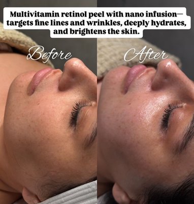 Multivitamin Retinol Peel - ✨ Multivitamin Retinal Glow Renewal ✨
Transform your skin with our advanced Multivitamin Retinal Peel enhanced with Nano Infusion technology. This treatment works to smooth fine lines, refine texture, boost collagen production, and deeply hydrate, leaving your skin radiant, refreshed, and healthy-looking—all with no downtime.
With immediate and noticeable results, it targets dullness, uneven skin tone, and early signs of aging, giving your complexion a lifted, glowing effect. Check out the before and after photos to see the difference just one session can make!
Ideal for anyone looking to rejuvenate their skin, improve texture, and restore a youthful glow—all in a single treatment. Multivitamin Retinol Peel - ✨ Multivitamin Retinal Glow Renewal ✨
Transform your skin with our advanced Multivitamin Retinal Peel enhanced with Nano Infusion technology. This treatment works to smooth fine lines, refine texture, boost collagen production, and deeply hydrate, leaving your skin radiant, refreshed, and healthy-looking—all with no downtime.
With immediate and noticeable results, it targets dullness, uneven skin tone, and early signs of aging, giving your complexion a lifted, glowing effect. Check out the before and after photos to see the difference just one session can make!
Ideal for anyone looking to rejuvenate their skin, improve texture, and restore a youthful glow—all in a single treatment.