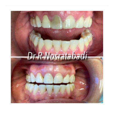 Teeth Whitening - A collection of teeth whitening cases from Dr. Rozita Nosratabadi Teeth Whitening - A collection of teeth whitening cases from Dr. Rozita Nosratabadi