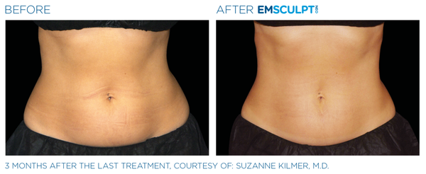 Body Sculpting - EMSCULPT NEO: The most revolutionary body contouring treatment for fat reduction and muscle building.

When you have excess fat, it makes your workouts harder. EMSCULPT NEO can help by reducing fat and increasing muscle contractions, saving you time and energy.

What is EMSCULPT NEO?

EMSCULPT NEO is the first non-invasive device that helps eliminate fat cells and build muscle in a single 30-minute treatment session.

The end result is less fat and more muscle, in less time and money.
Best of all, EMSCULPT NEO has a broad appeal as it can treat patients up to BMI 35.

How Does EMSCULPT NEO Work?

EMSCULPT NEO is a non-invasive treatment that simultaneously combines Radiofrequency heating and HIFEM procedure to reduce fat and build muscle.

The treatment helps eliminate and removes fat cells from the body while also causing muscle growth through intense muscle contractions.

Clinical studies have shown an average of 30% reduction in subcutaneous fat and a 25% increase in muscle thickness with EMSCULPT NEO.

EMSCULPT NEO can be applied over 10 body areas, such as the abdomen, flanks, buttocks, thighs, arms & calves.

The treatment protocol typically includes four 30-minute sessions scheduled 5-10 days apart.  (The standard protocol is 4 sessions but most patients choose to do more!)

You may start to notice tangible results immediately after the treatments. Optimal results are typically observed 90 days after the final session and can continue improving for several weeks after the treatment.

There is no downtime with this procedure. You can get back to your daily routine right after the treatment.

After the treatment, the fat cells die and are naturally eliminated from the body through metabolic processes.

EMSCULPT NEO treatments may feel intense but should never be painful.