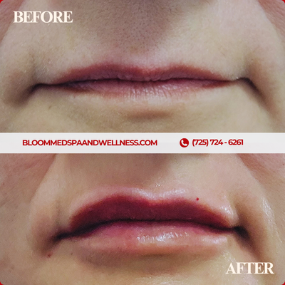 Fillers - Pucker up and create the lips you desire by restoring or adding volume with fillers. Reduce the appearance of “smoker” lines in the upper lip as well!