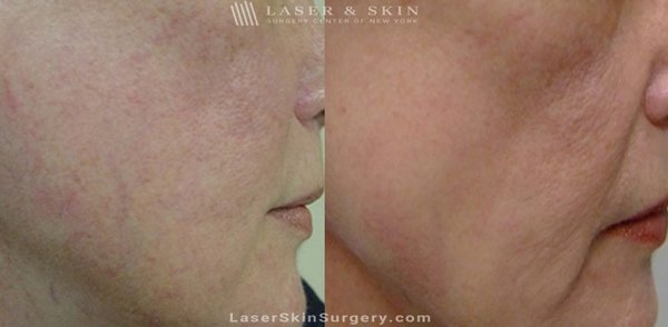 Rosacea, Red Spots, Blood Vessels Before & Afters - Rosacea is an inflammatory condition that causes chronic facial redness and visible blood vessels. Though rosacea is primarily a cosmetic concern, it tends to worsen and spread over time. Without treatment, rosacea flare-ups can diminish your self-esteem and damage your skin.
Our team of board-certified dermatologists perform a wide selection of laser treatments to repair damage from rosacea, minimize the appearance of broken blood vessels, and significantly improve facial redness. Rosacea, Red Spots, Blood Vessels Before & Afters - Rosacea is an inflammatory condition that causes chronic facial redness and visible blood vessels. Though rosacea is primarily a cosmetic concern, it tends to worsen and spread over time. Without treatment, rosacea flare-ups can diminish your self-esteem and damage your skin.
Our team of board-certified dermatologists perform a wide selection of laser treatments to repair damage from rosacea, minimize the appearance of broken blood vessels, and significantly improve facial redness.