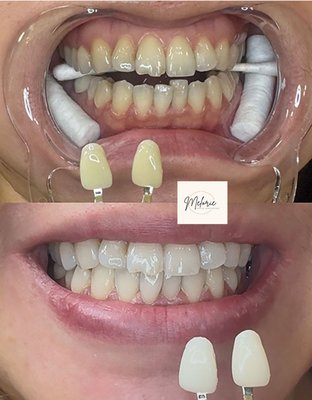 Teeth Whitening - 🪥Zero to minimal sensitivity
🪥immediate results
🪥3-18 shade difference
🪥Plant & mineral products Teeth Whitening - 🪥Zero to minimal sensitivity
🪥immediate results
🪥3-18 shade difference
🪥Plant & mineral products