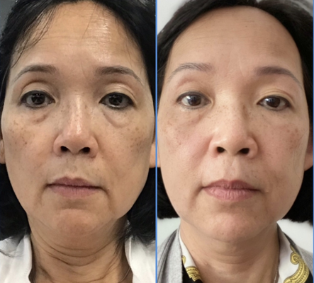 Endosphères Face Lift and Cellulite treatment - Quick result
100% non-invasive
Effective and Safe
Face lifting and wrinkle reduction
Endosphères Therapy treatments offer complete facial rejuvenation*. The treatment works beneath the skin to improve tone, even out complexion, tackle dark circles, and reduce eye bags. The results are immediate* and accelerates the production of collagen, elastin and hyaluronic acid to revive tired, dull or sagging complexions and re-awaken your natural beauty.
BODY TREATMENTS
The Compressive Microvibration Method used within Endosphères Therapy is the latest full body treatment on the market that allows you to target the areas of your body that you want to improve! Our treatments are effective on the whole body, from your forehead to your feet, and tackle everything from rejuvenation, to the reduction of cellulite and muscle toning*.
*Result vary from person to person
*For best results the course is recommended
*Consultation required Endosphères Face Lift and Cellulite treatment - Quick result
100% non-invasive
Effective and Safe
Face lifting and wrinkle reduction
Endosphères Therapy treatments offer complete facial rejuvenation*. The treatment works beneath the skin to improve tone, even out complexion, tackle dark circles, and reduce eye bags. The results are immediate* and accelerates the production of collagen, elastin and hyaluronic acid to revive tired, dull or sagging complexions and re-awaken your natural beauty.
BODY TREATMENTS
The Compressive Microvibration Method used within Endosphères Therapy is the latest full body treatment on the market that allows you to target the areas of your body that you want to improve! Our treatments are effective on the whole body, from your forehead to your feet, and tackle everything from rejuvenation, to the reduction of cellulite and muscle toning*.
*Result vary from person to person
*For best results the course is recommended
*Consultation required