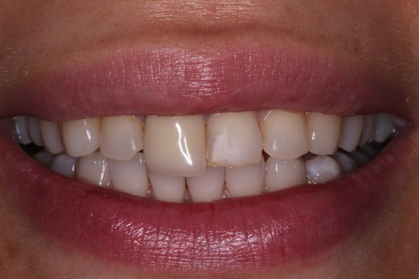 Veneers - E.Max Veneers on two front teeth #8,9. Veneers - E.Max Veneers on two front teeth #8,9.