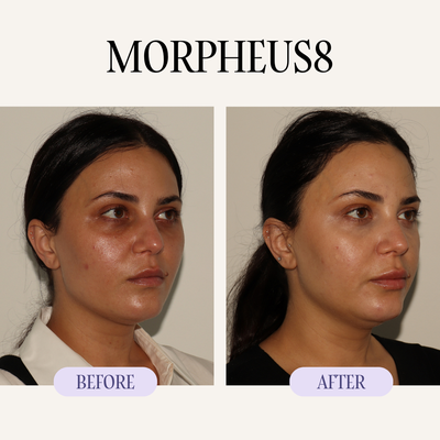 Skincare Treatments with Laser and Injectables - We offer advanced skin rejuvenation treatments including V-Beam, Morpheus8, Fotona laser, Hydrafacial, and microneedling with PRP. These treatments target acne scars, sun damage, redness, pigmentation, fine lines, and uneven texture.
By stimulating collagen production and improving skin clarity, our laser and injectable treatments promote smoother, healthier-looking skin with minimal downtime. Skincare Treatments with Laser and Injectables - We offer advanced skin rejuvenation treatments including V-Beam, Morpheus8, Fotona laser, Hydrafacial, and microneedling with PRP. These treatments target acne scars, sun damage, redness, pigmentation, fine lines, and uneven texture.
By stimulating collagen production and improving skin clarity, our laser and injectable treatments promote smoother, healthier-looking skin with minimal downtime.