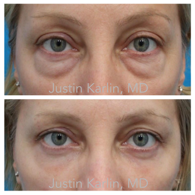 Lower Blepharoplasty - Lower eyelid surgery is the most technique-sensitive operation we perform, and the cases here show the approach: treat everything that ages the lower lid — not just the bag.
Each surgery is customized across three layers. Volume: the bulging fat is conservatively sculpted through an incision hidden inside the eyelid (no external scar), and the hollow beneath is restored with a bespoke transfer of the patient's own fat. Support: the lid margin is reinforced only when the exam shows laxity, preserving the eye's natural almond shape. Surface: where skin texture is part of the picture, nanofat or CO₂ laser resurfacing is planned with the surgery.
Over-removing fat is what creates the hollow, "operated" look. Sculpting and restoring instead is why these results read as rested — the same eyes, without the tiredness.
All photos shown with patient consent; individual results vary. More consented cases, each labeled with the exact procedures performed: justinkarlin.com/results
Justin Karlin, MD — ABO board-certified ophthalmologist and ASOPRS-certified oculofacial plastic surgeon · Beverly Hills Lower Blepharoplasty - Lower eyelid surgery is the most technique-sensitive operation we perform, and the cases here show the approach: treat everything that ages the lower lid — not just the bag.
Each surgery is customized across three layers. Volume: the bulging fat is conservatively sculpted through an incision hidden inside the eyelid (no external scar), and the hollow beneath is restored with a bespoke transfer of the patient's own fat. Support: the lid margin is reinforced only when the exam shows laxity, preserving the eye's natural almond shape. Surface: where skin texture is part of the picture, nanofat or CO₂ laser resurfacing is planned with the surgery.
Over-removing fat is what creates the hollow, "operated" look. Sculpting and restoring instead is why these results read as rested — the same eyes, without the tiredness.
All photos shown with patient consent; individual results vary. More consented cases, each labeled with the exact procedures performed: justinkarlin.com/results
Justin Karlin, MD — ABO board-certified ophthalmologist and ASOPRS-certified oculofacial plastic surgeon · Beverly Hills